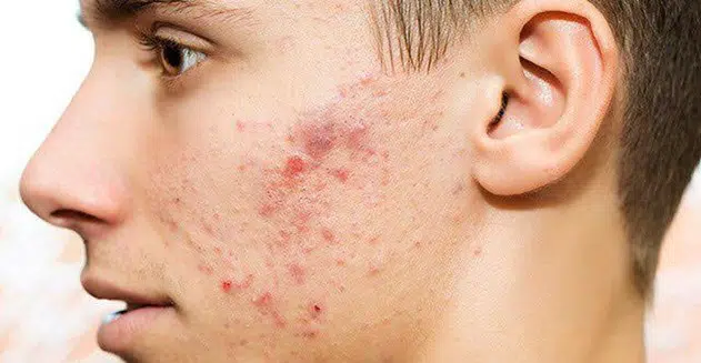 بررسی علل جوش صورت