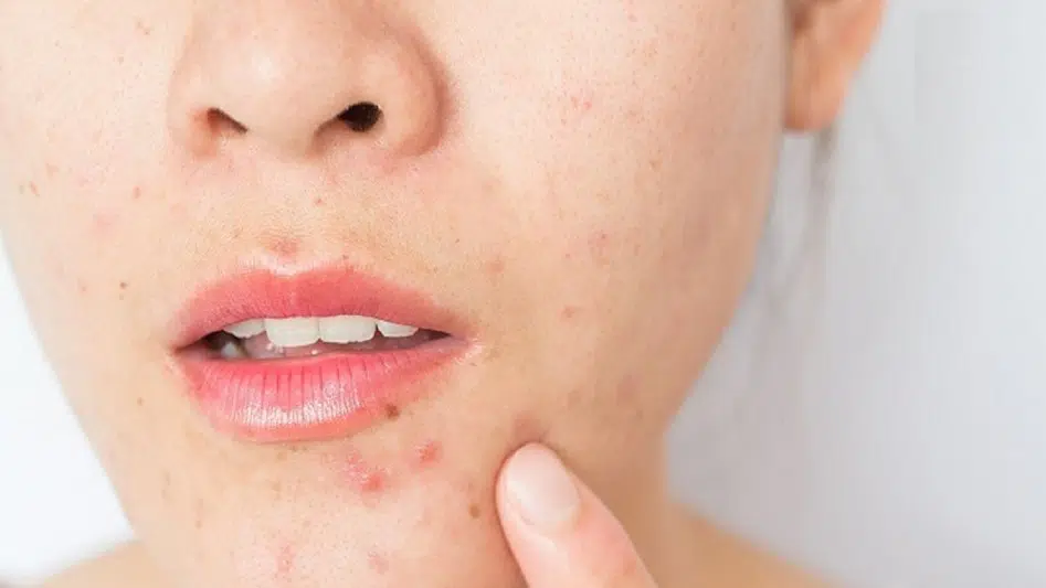 استفاده از گرما