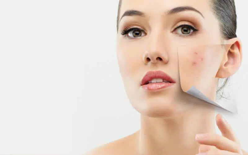 بهترین کرم های ضد آکنه