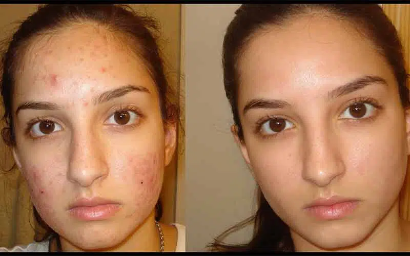 بهترین کرم های ضد جوش