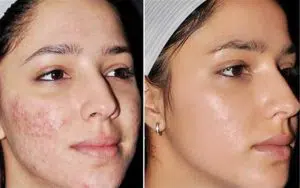 بهترین کرم های ضد جوش