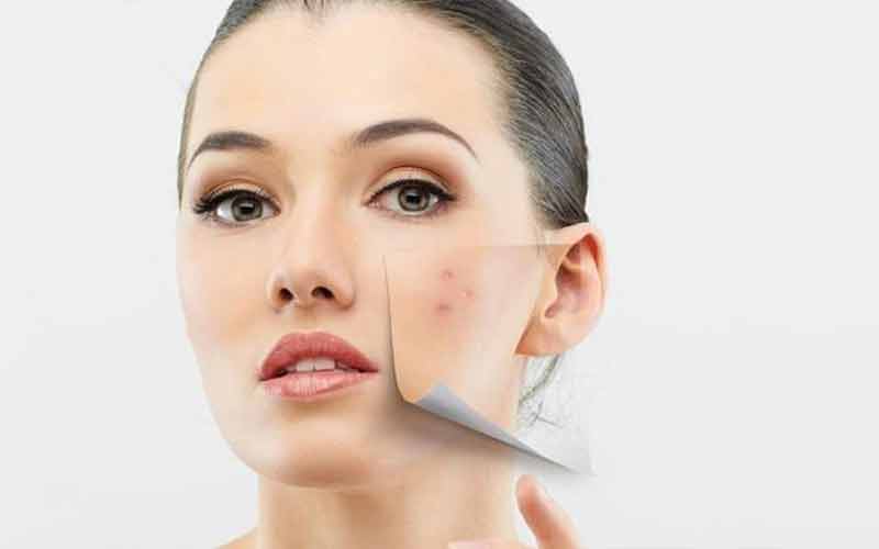 بهترین کرم ضد لک