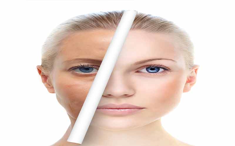 بهترین کرم ضد لک
