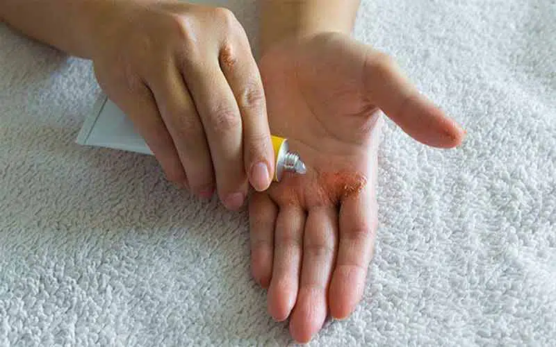 بهترین کرم برای درمان اگزما