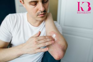 کرم اوره برای اگزما