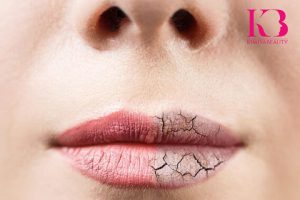 خشکی لب نشانه چیست؟